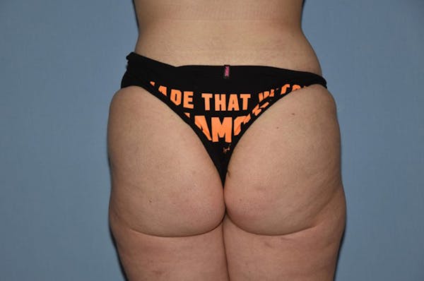 Liposuction Gallery - Patient 6389659 - Image 2
