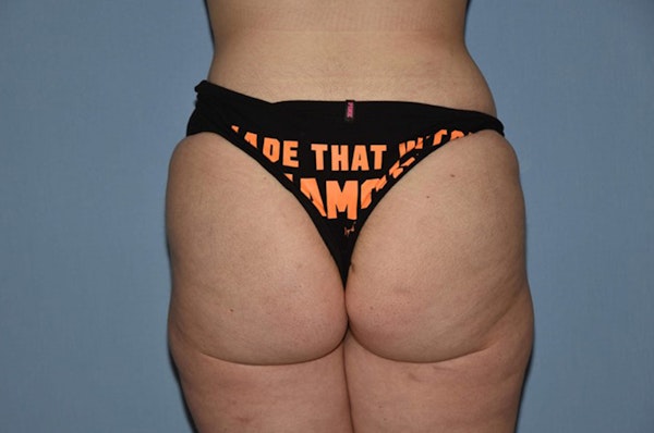 Liposuction Before & After Gallery - Patient 6389659 - Image 2