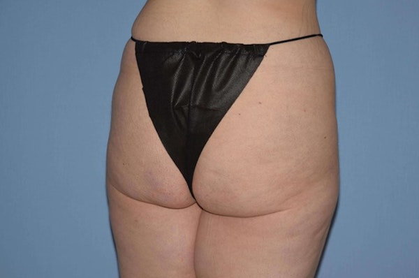 Liposuction Before & After Gallery - Patient 6389659 - Image 3