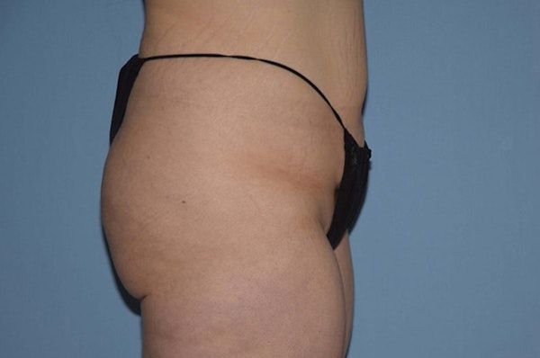 Liposuction Before & After Gallery - Patient 6389659 - Image 5