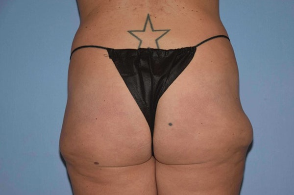 Liposuction Before & After Gallery - Patient 6389661 - Image 1