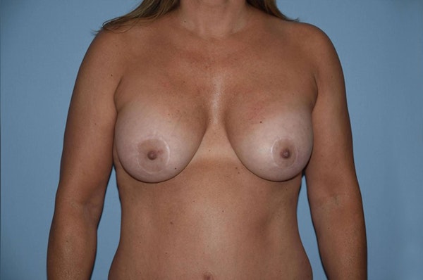Mommy Makeover Before & After Gallery - Patient 6389589 - Image 2