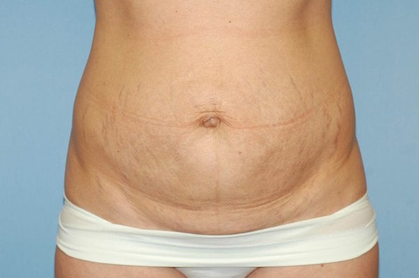 Mommy Makeover Before & After Gallery - Patient 6389602 - Image 5