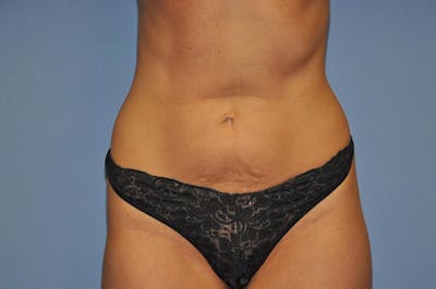 Mommy Makeover Before & After Gallery - Patient 6389612 - Image 1