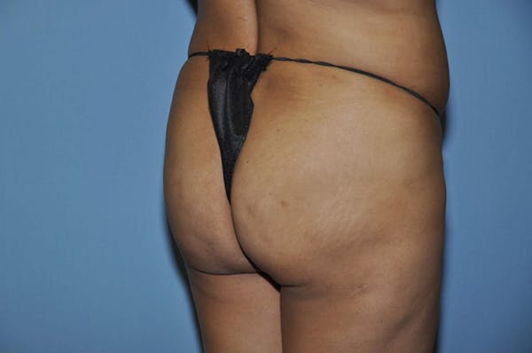 Brazilian Butt Lift Before & After Gallery - Patient 6389575 - Image 3