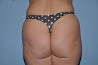 Brazilian Butt Lift Gallery - Patient 6389576 - Image 1