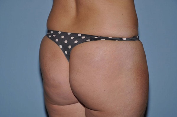Brazilian Butt Lift Before & After Gallery - Patient 6389576 - Image 3