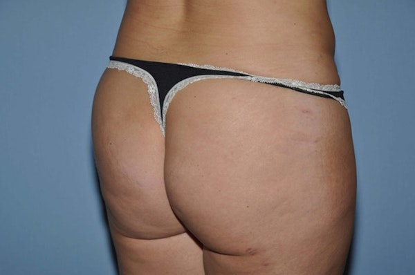 Brazilian Butt Lift Before & After Gallery - Patient 6389576 - Image 4