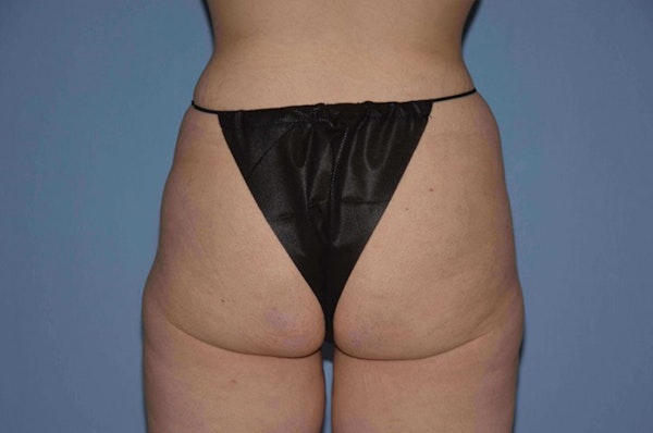 Brazilian Butt Lift Before & After Gallery - Patient 6389578 - Image 1