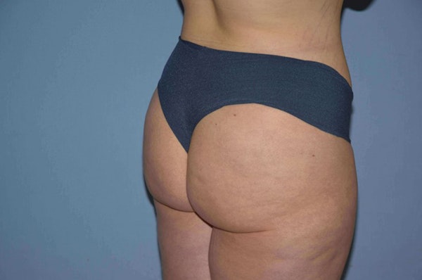 Brazilian Butt Lift Before & After Gallery - Patient 6389578 - Image 4