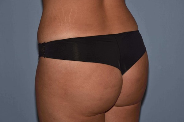 Brazilian Butt Lift Before & After Gallery - Patient 6389580 - Image 2