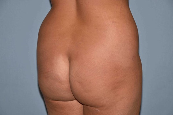Brazilian Butt Lift Before & After Gallery - Patient 6389580 - Image 3