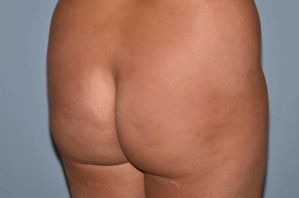 Brazilian Butt Lift Gallery - Patient 6389580 - Image 5