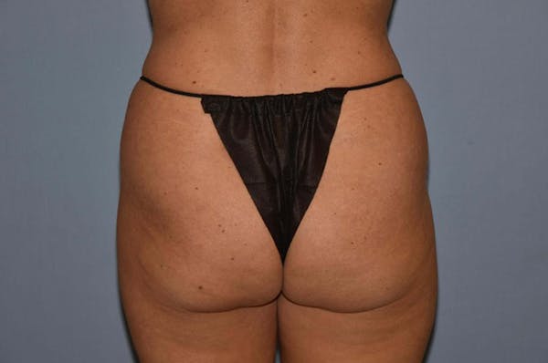 Brazilian Butt Lift Gallery - Patient 6389581 - Image 1