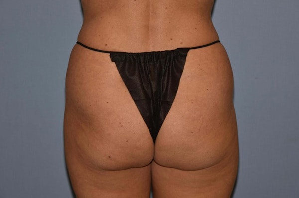 Brazilian Butt Lift Before & After Gallery - Patient 6389581 - Image 1