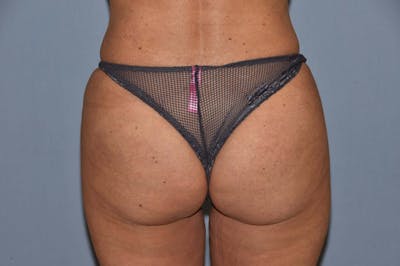 Brazilian Butt Lift Before & After Gallery - Patient 6389581 - Image 2