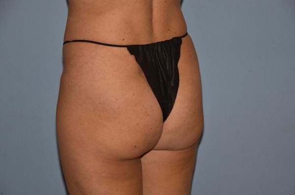 Brazilian Butt Lift Before & After Gallery - Patient 6389581 - Image 3