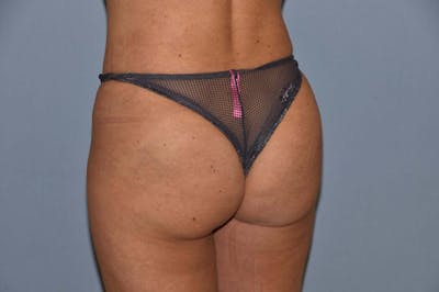 Brazilian Butt Lift Before & After Gallery - Patient 6389581 - Image 4