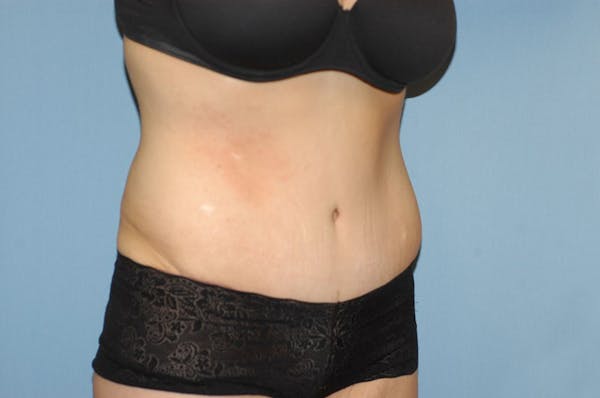 After Weight Loss Surgery Gallery - Patient 6389617 - Image 4