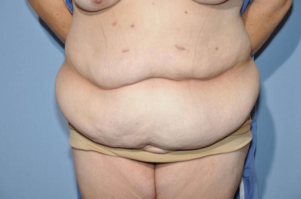 After Weight Loss Surgery Before & After Gallery - Patient 6389619 - Image 1