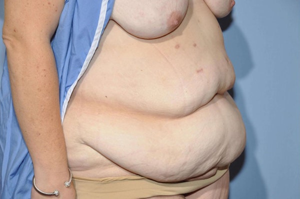 After Weight Loss Surgery Before & After Gallery - Patient 6389619 - Image 3