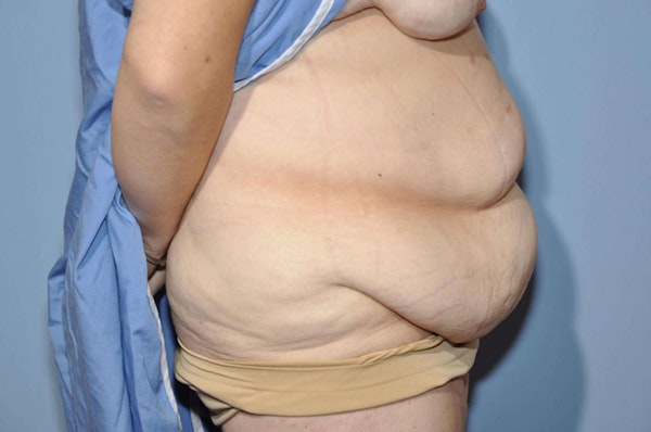After Weight Loss Surgery Before & After Gallery - Patient 6389619 - Image 5