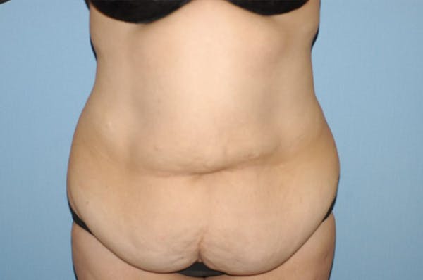 After Weight Loss Surgery Before & After Gallery - Patient 6389623 - Image 1
