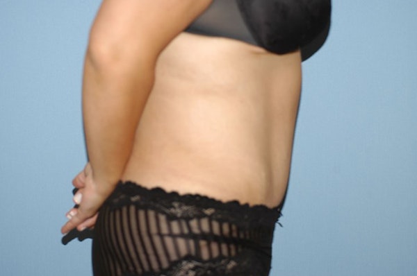 After Weight Loss Surgery Before & After Gallery - Patient 6389623 - Image 6