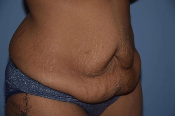 After Weight Loss Surgery Before & After Gallery - Patient 6389625 - Image 3