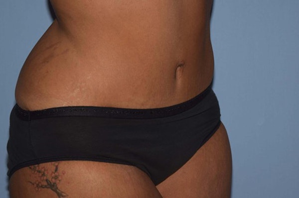 After Weight Loss Surgery Before & After Gallery - Patient 6389625 - Image 4