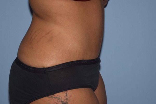 After Weight Loss Surgery Before & After Gallery - Patient 6389625 - Image 6