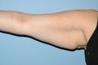 Arm Lift Before & After Gallery - Patient 6389566 - Image 1