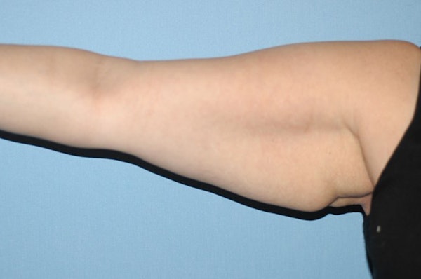 Arm Lift Before & After Gallery - Patient 6389566 - Image 1