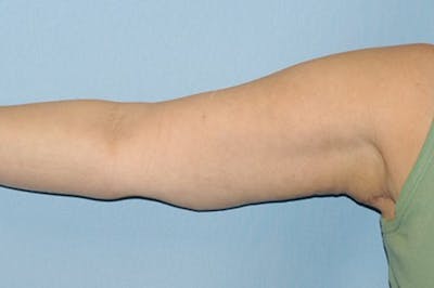Arm Lift Before & After Gallery - Patient 6389566 - Image 2