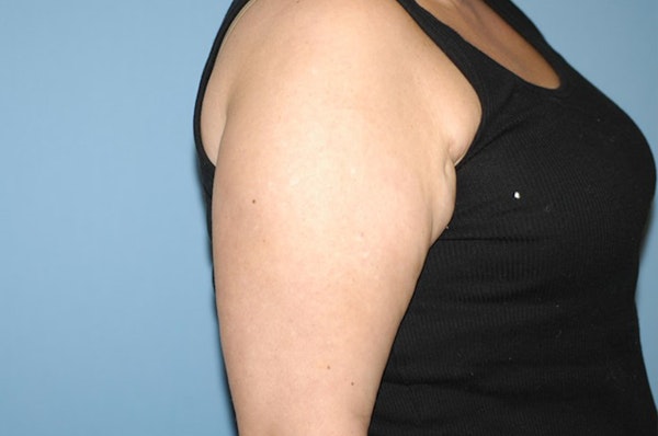 Arm Lift Before & After Gallery - Patient 6389566 - Image 3