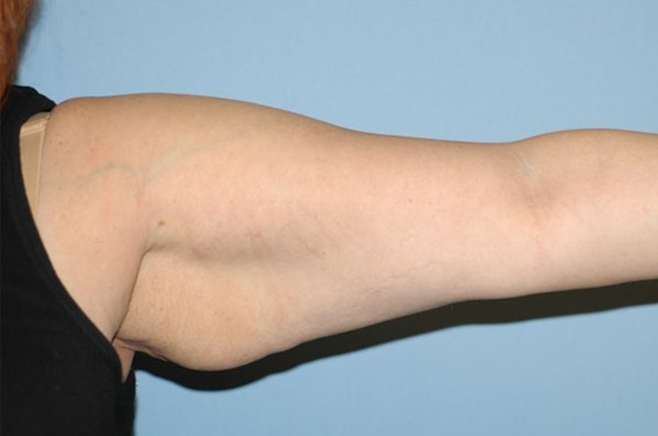 Arm Lift Before & After Gallery - Patient 6389566 - Image 5