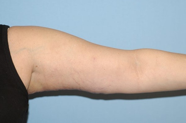 Arm Lift Before & After Gallery - Patient 6389566 - Image 6