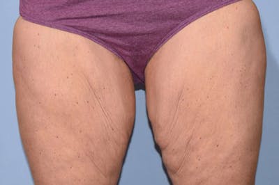 Thigh Lift Before & After Gallery - Patient 6389547 - Image 1