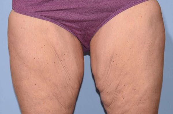 Thigh Lift Gallery - Patient 6389547 - Image 1
