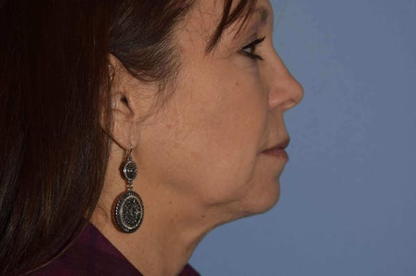 Facelift Before & After Gallery - Patient 6389895 - Image 5