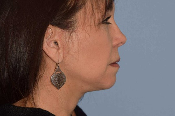 Facelift Before & After Gallery - Patient 6389895 - Image 6