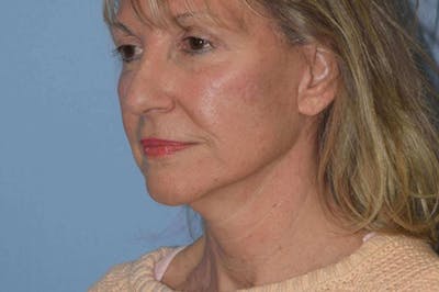 Facelift Before & After Gallery - Patient 6389896 - Image 4