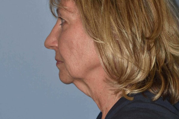 Facelift Before & After Gallery - Patient 6389896 - Image 5