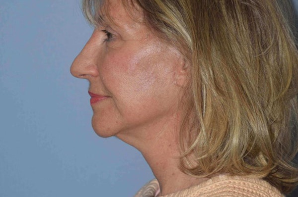 Facelift Before & After Gallery - Patient 6389896 - Image 6