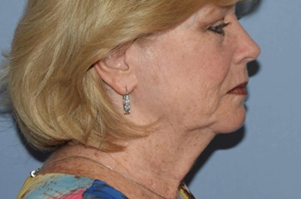Facelift Before & After Gallery - Patient 6389901 - Image 5