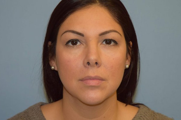 Facelift Before & After Gallery - Patient 6389904 - Image 1