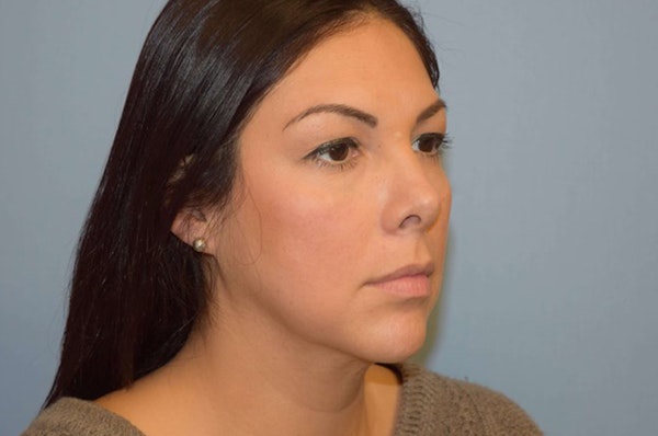 Facelift Before & After Gallery - Patient 6389904 - Image 3