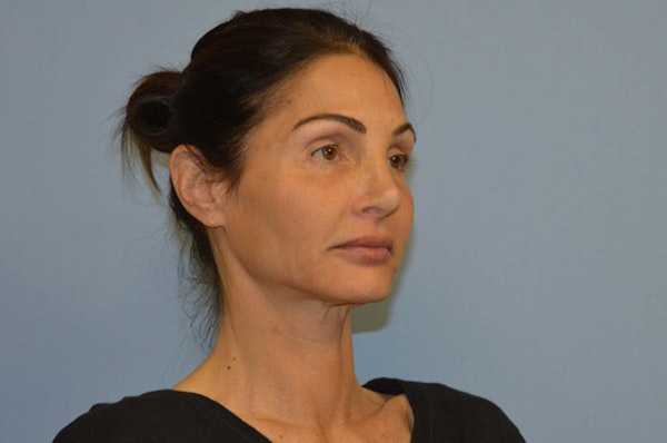 Facelift Before & After Gallery - Patient 6389906 - Image 3