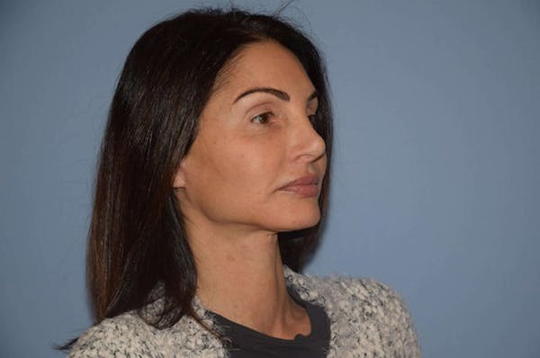 Facelift Before & After Gallery - Patient 6389906 - Image 4
