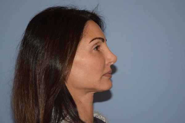 Facelift Before & After Gallery - Patient 6389906 - Image 6